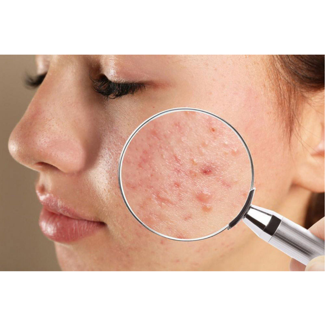 Acne & Breakouts