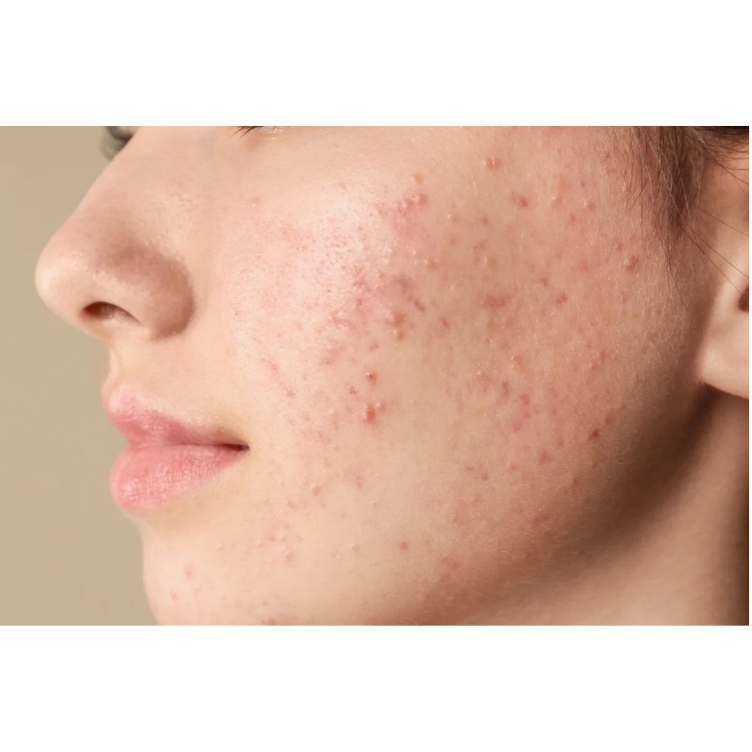 Clogged pores