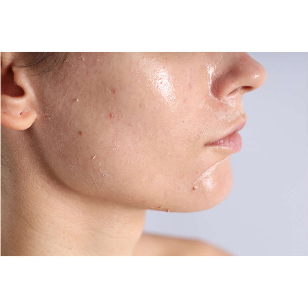 Combination Skin