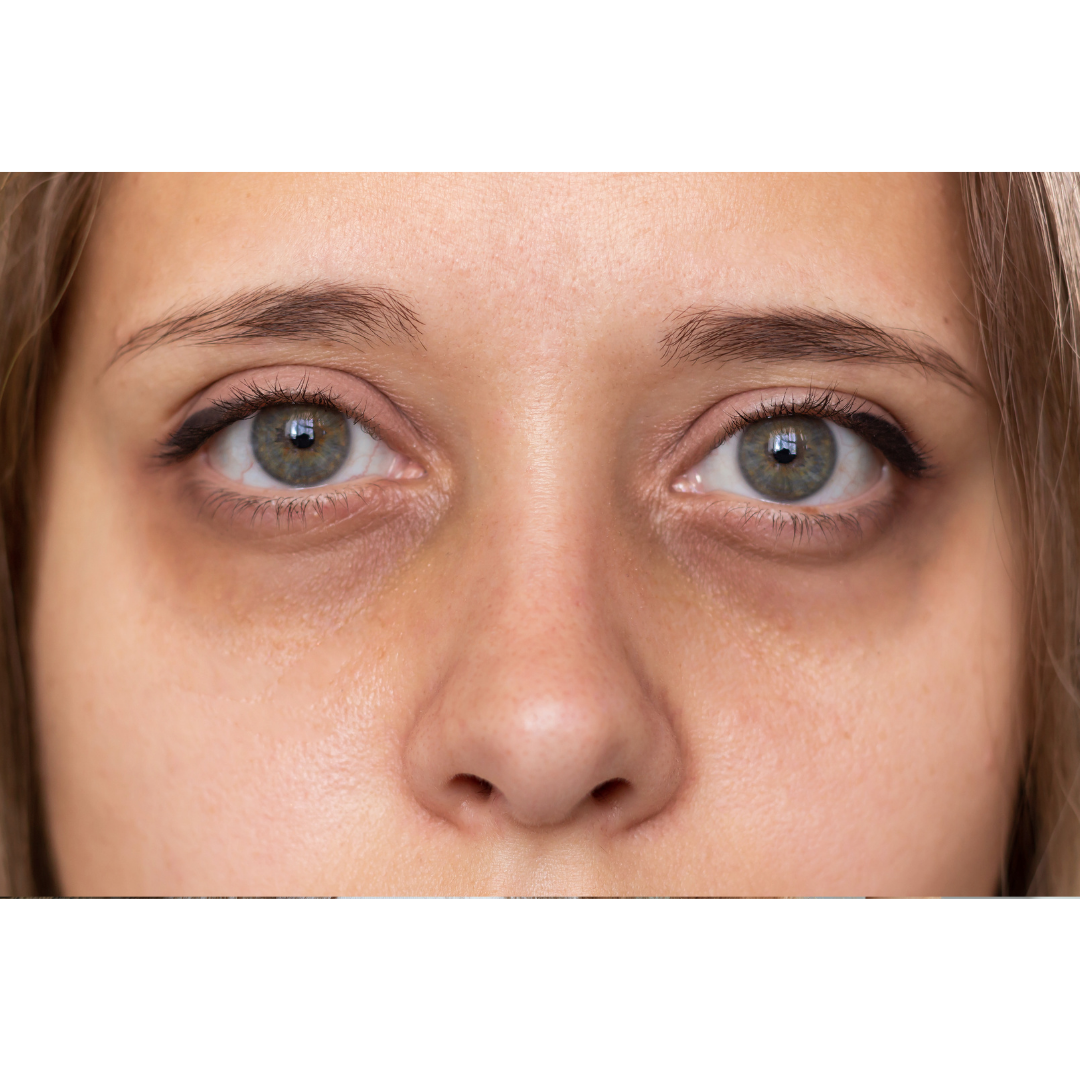 Dark Circles